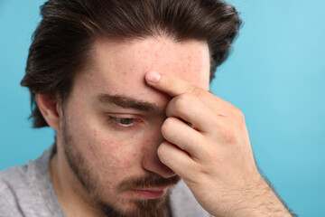 Young man with acne problem on light blue background, closeup