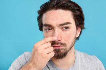 Young man with acne problem on light blue background