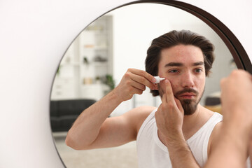 Young man with acne problem applying cream onto his face near mirror at home