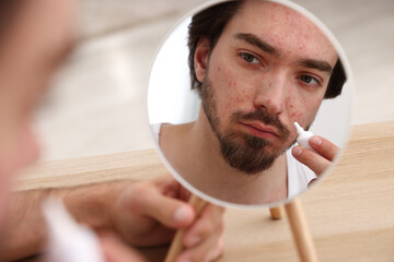 Young man with acne problem applying cream onto his face near mirror at table indoors