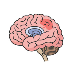 brain stroke illustration showing hemorrhage on cerebrum affecting function and health for medical content