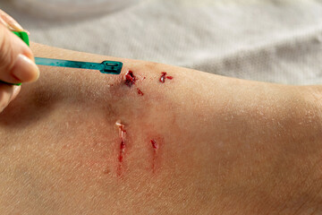 Woman applying disinfectant to several fresh bloody cat bite wounds and scratches on her leg, first aid concept.