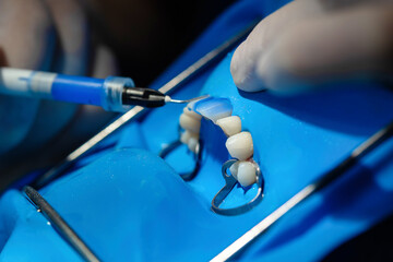 Macro view of dental etching gel applied to isolated teeth under rubber dam. Step in adhesive...