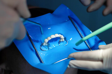 Close-up of dentist rinsing off blue etching gel with water and suction. Step in adhesive dentistry...