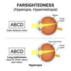 Hyperopia  Hypermetropia - Farsightedness Eye Flashcard Illustration