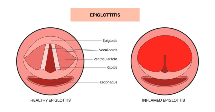 Epiglottitis medical poster
