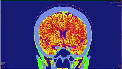 Magnetic resonance color images of the brain, top view, MRI of the brain, of a patient with multiple vascular infarctions, 3x3 image grid, color animation Seamless Loop. High quality 4k footage
