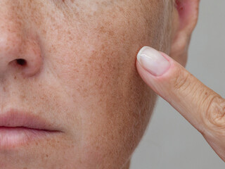 Partial facial close-up of a woman pointing at freckles