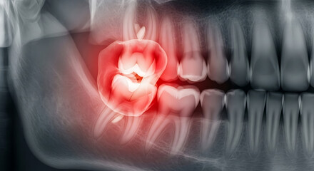 Tooth Radiograph Illustrating Wisdom Tooth Impaction A Dental X-Ray Analysis