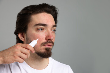Young man with acne problem applying cream onto his face on light grey background. Space for text