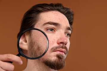Young man with acne problem holding magnifying glass near his face on brown background, closeup