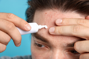 Young man with acne problem applying cream onto his face on light blue background, closeup