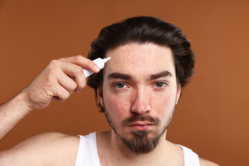 Young man with acne problem applying cream onto his face on brown background