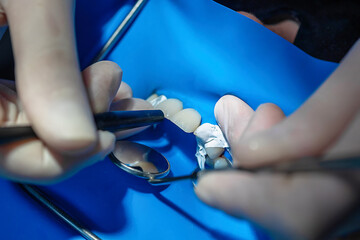 Close-up of dentist pressing dental veneers onto isolated front teeth using black applicator...