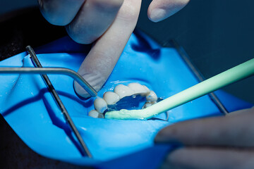 Close-up of dentist rinsing off blue etching gel with water and suction. Step in adhesive dentistry...