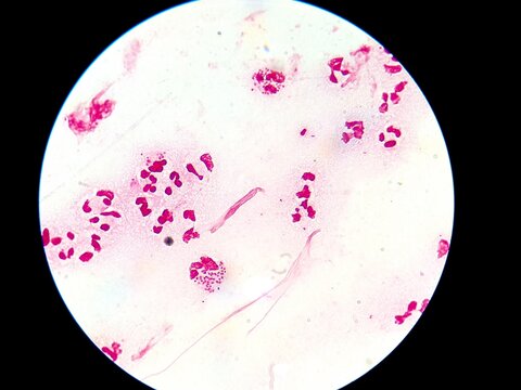 Intracellular Neisseria gonorrhoeae bacteria with gram staining, viewed under a microscope.