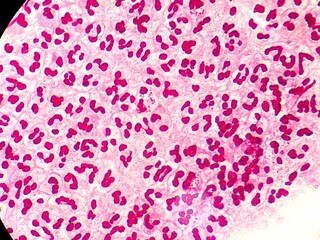 Intracellular Neisseria gonorrhoeae bacteria with gram staining, viewed under a microscope.