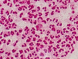 Intracellular Neisseria gonorrhoeae bacteria with gram staining, viewed under a microscope.