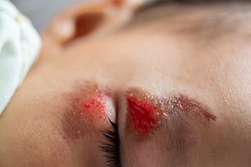 Close-up of a painful wound on the forehead of an Asian child from a deep wound from falling down the stairs. Fresh wound.