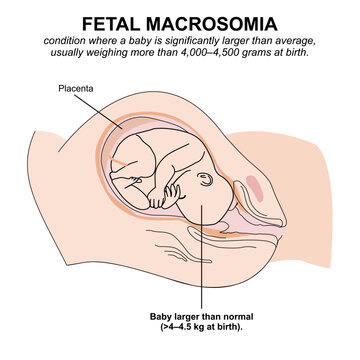Fetal Macrosomia medical flashcard illustration