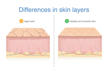 Differences of skin layer between Aged skin by deep wrinkles and dryness and healthy and smooth skin layer. Problems in epidermis and dermis from aging.