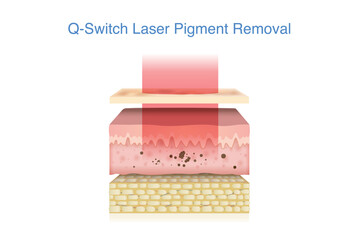 Q Switch laser shatters pigment, fading dark spot on skin layer. Illustration about Derma technology for removing unwanted pigment such as from tattoos, freckles, age spots, and melasma.