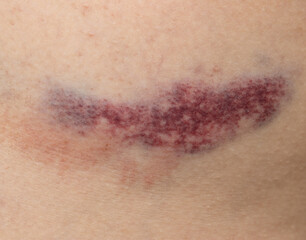 Fototapeta premium A bruise on a person's arm