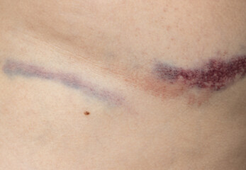 A scar on a person's arm