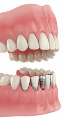 Obraz premium Close up of teeth with dental implants and gums showing the upper and lower jaw structure