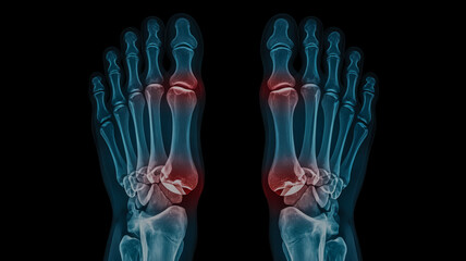 X-ray of human feet showing inflammation and pain in the toes and metatarsals skeleton bone