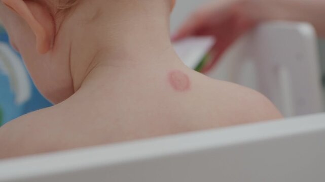Mosquito bite on child back in a playful indoor setting during daytime