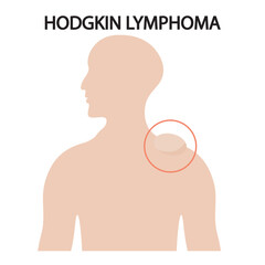 Flat vector illustration of Hodgkin lymphoma highlighting symptoms like swollen lymph nodes, fatigue, fever, night sweats, and similar diseases such as non-Hodgkin lymphoma.