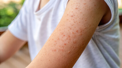 Inflamed skin arm closeup rash dry skin red bump textured irritation atopic dermatitis gently shows concern and hope in natural light