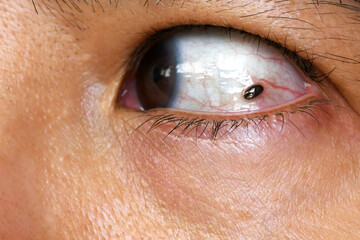 Mole in woman eye. Ocular melanoma in the eye.