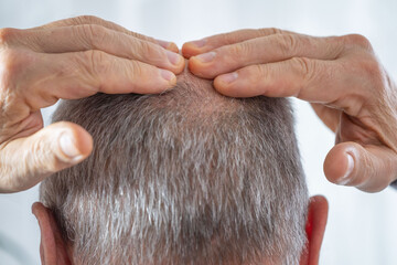 Mature bald man facing hair loss, no comb needed, considering trichology solutions, male baldness...