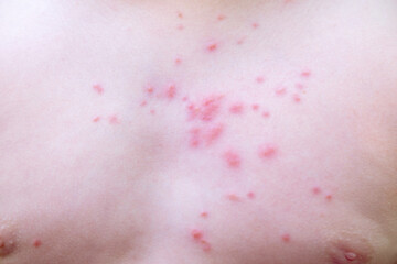 human skin covered in red, itchy rash, 11-year-old child with rash on body, symptoms eczema, chickenpox, allergic reaction or mosquito bites