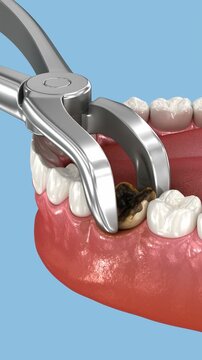 Extraction of tooth. Dental 3D animation