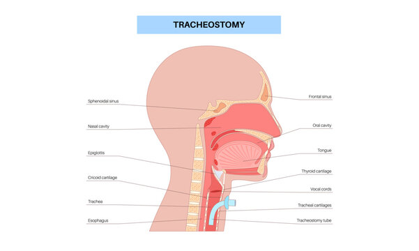 Tracheostomy medical poster