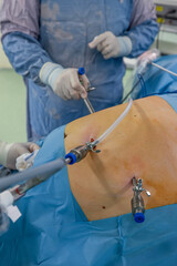 Bariatric surgeon performing a gastric sleeve procedure to treat obesity, close-up of hands and...