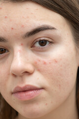 Portrait of young woman with acne on her face, close-up. Acne, skin care concept. Real photo.