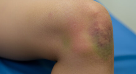 Fototapeta premium Bruised knee with varying colors on medical examination table 