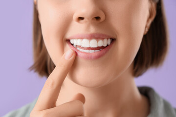 Young woman with occlusal splint on lilac background, closeup