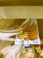 Nurse Checking Urine Bag with Blood Indication of Hematuria
