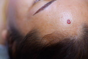 Cherry Angioma on the face.