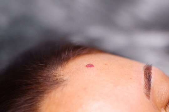Cherry Angioma on the face.