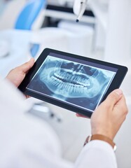 Hands, dentist and tablet screen for x ray, teeth diagnosis or plan for healthcare treatment