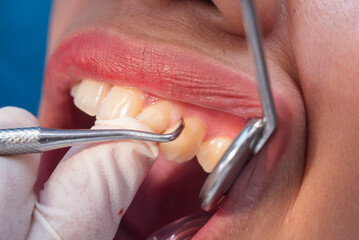 A detailed close up shot showing a dentist meticulously scraping plaque and tartar off the tooth...