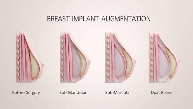 Breast implant placement techniques with submuscular subglandular and dual plane cross section 3d render