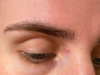 Detailed macro photo of inflamed pimple near eyebrow. Ideal for skincare, cosmetic issues, dermatology concepts, and educational visual materials.