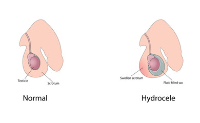 Hydrocele vector illustration